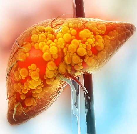 नॉन एल्कोहॉलिक फैटी लिवर डिसीज